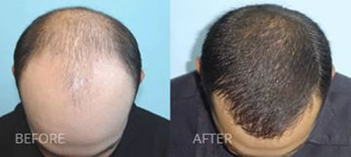hair regenerated by stem cell treatment